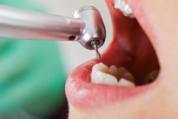 Best Emergency Dental Care for Abscessed Tooth in Troy, MO
